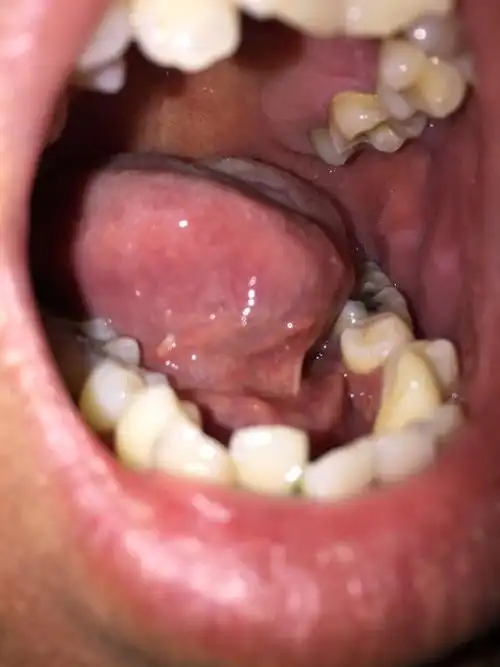 舌根处白色是啥老聚散,碰到有点痛