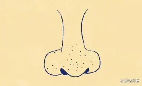 蒜头鼻怎么变小?不通过整容的方式