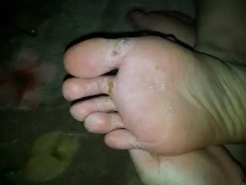 去年10月份开始我的脚就患有糜烂型脚气病,而且会很痒,想把脚扣烂的