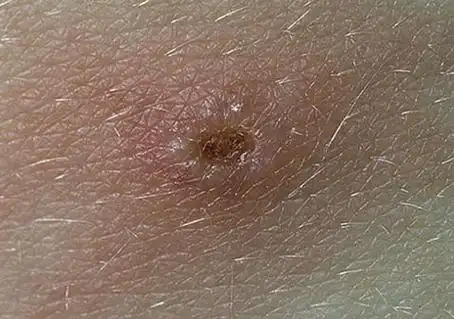 梅毒初期症状皮疹图片 梅毒一开始的征兆图片