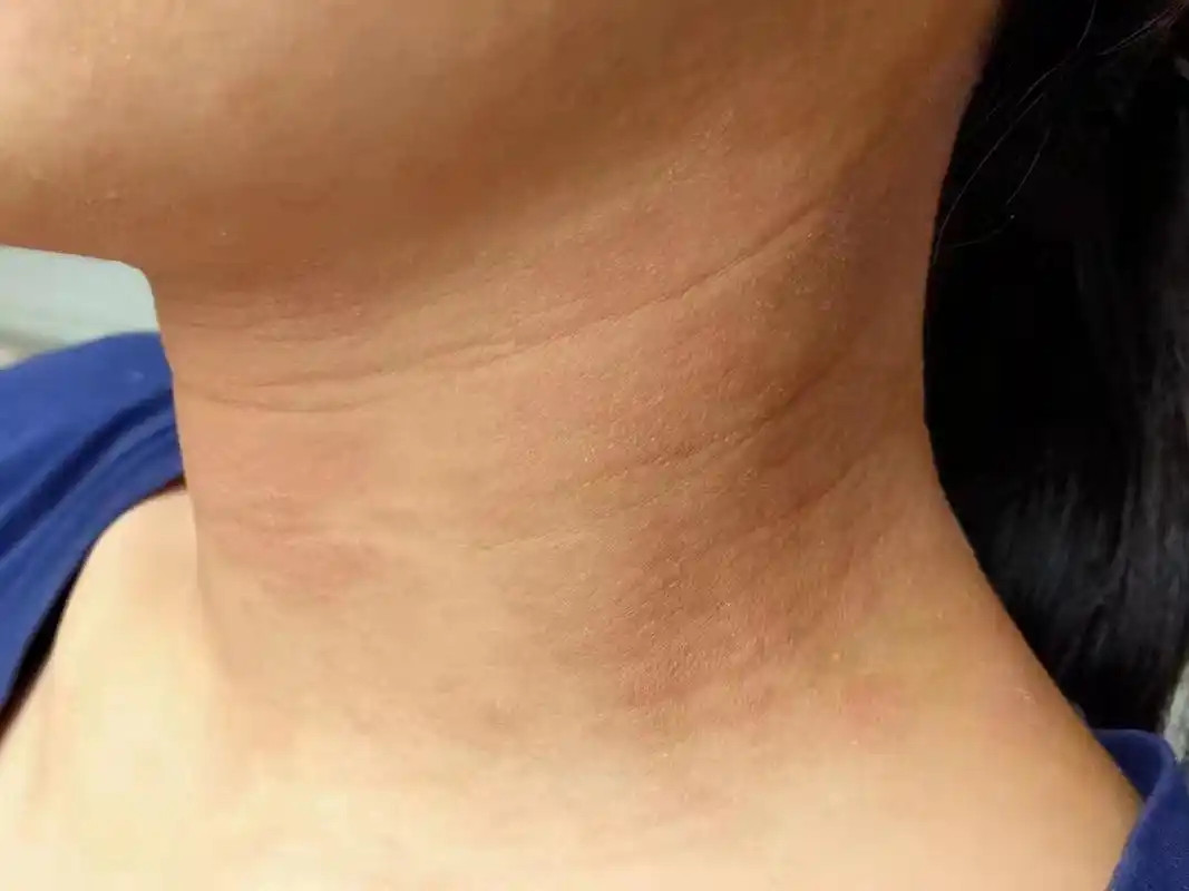 干性湿疹应该如何处理