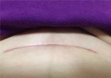 所以不管如何来看,伤口的面积大小已经决定了伤口的复原情况,虽然侧切