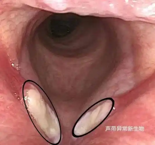 46岁,主诉"感冒后声音嘶哑1月余",自行服用抗生素类药物史,喉镜检查