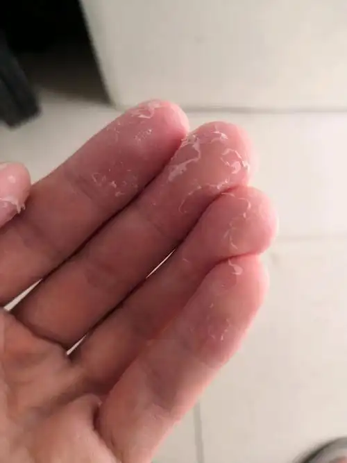 如何应对和预防宝宝手脱皮|手癣|手脱皮|脱皮_新浪新闻