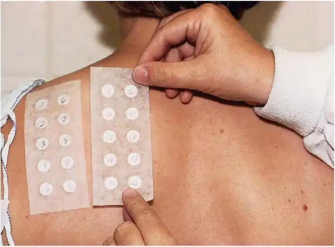 斑贴试验是采用少量物质直接接触皮肤,一段时间后观察接触部位是否