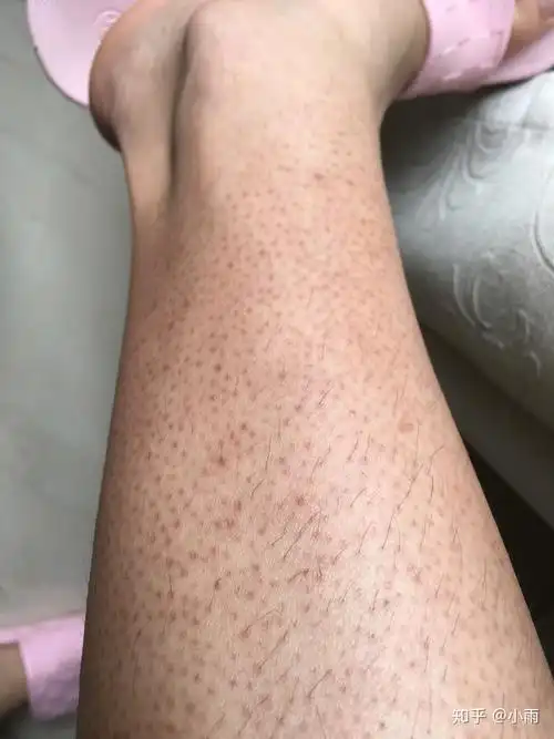 我患有严重的毛周角化症色素沉淀很严重夏天只能长裙长裤男生会介意吗