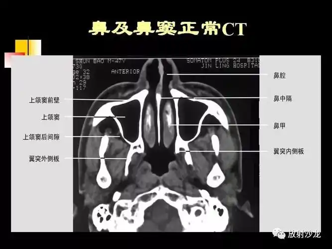 鼻及鼻窦的影像诊断