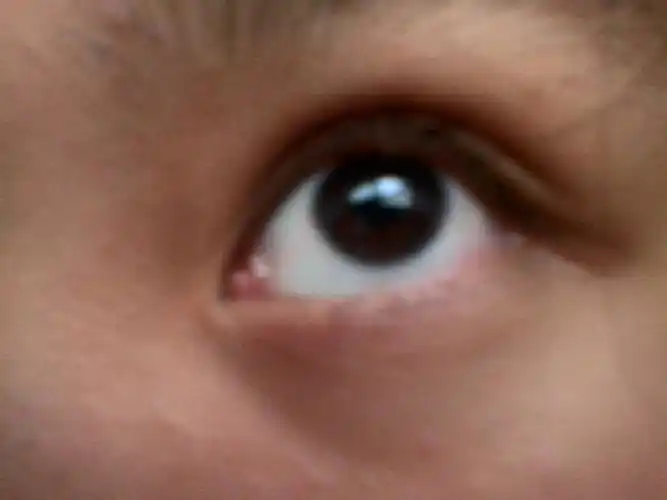 湖南省衡阳市169中心医院 答: 这是泪阜部位结膜变形增生所形成的表现