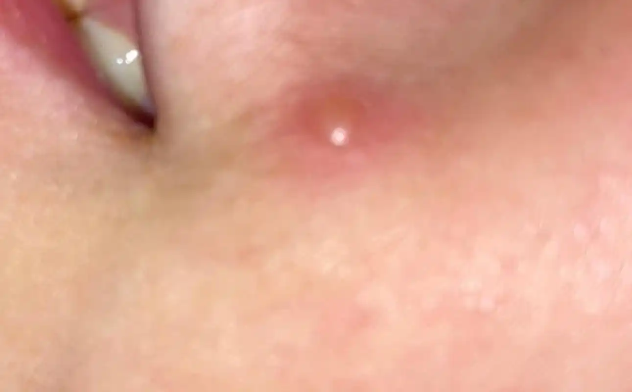 孩子出水痘,第一天发烧,第二天出痘,第三天发烧,第四天退烧,现在第五