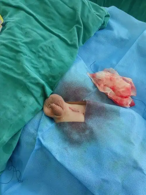 孩子的"蛋蛋"一下子就减轻了许多