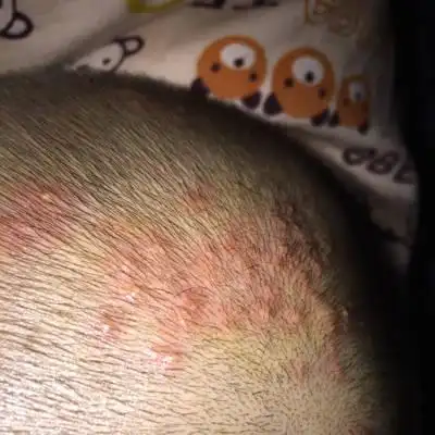 你好,我家宝贝头上起红色疙瘩,有时会冒白头,请问这怎麼办