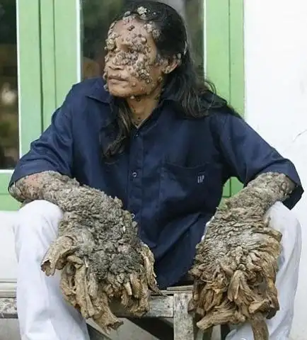 恐怖,比象腿人更恐怖的病 - 生活杂谈 - 梅州时空网 - powered by dis