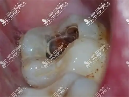 后槽牙烂了个大窟窿疼怎么办有人说拔后槽牙后悔死了