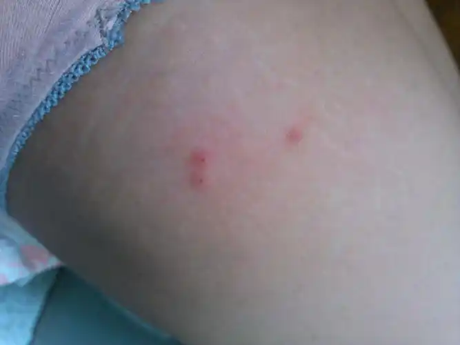 夹板蠼螋qúsōu咬人后的伤口图片家里出现蠼螋预示着什么