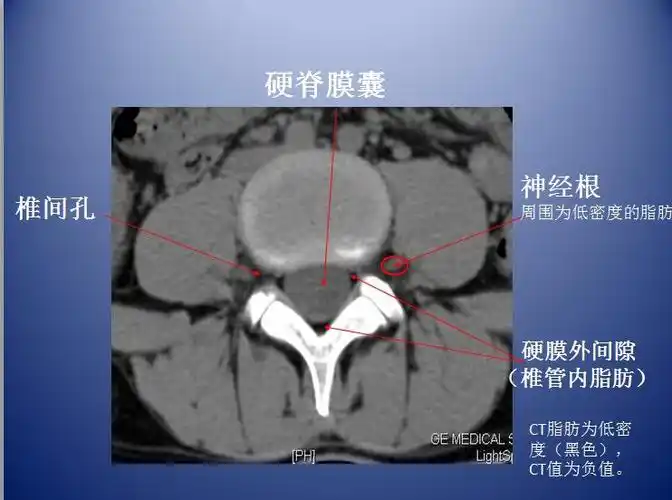脊柱ct,mr断层解剖2