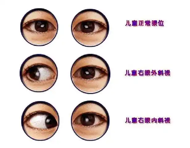 给"对眼宝宝"的一点启示-陈金艳主治医师-爱问医生