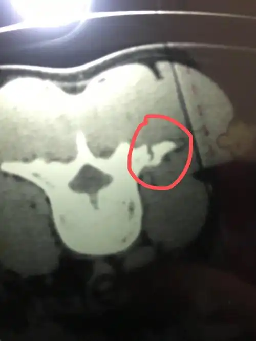 腰3椎体右侧横突骨折能够评伤残吗?