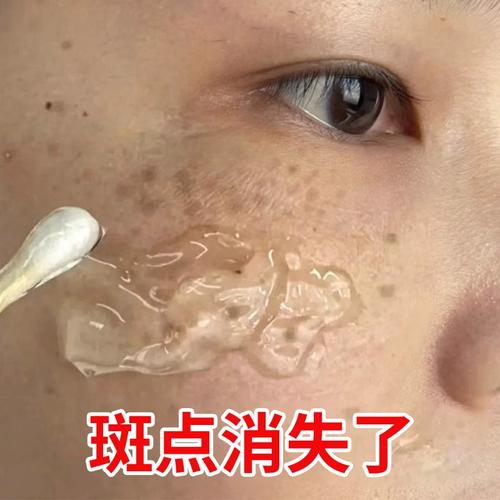 【屈臣氏推荐】祛脸上黑点斑点 斑迹 脸上干干净净 跟斑点说拜拜