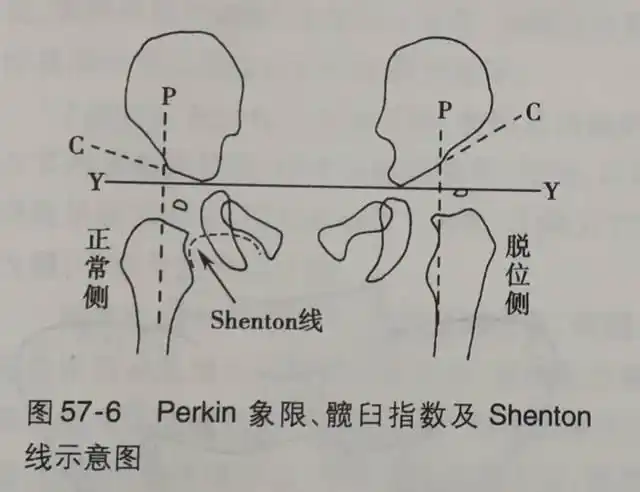 (1)  髋臼指数 (acetabular index):髋关节的发育状况常用髋臼指数或