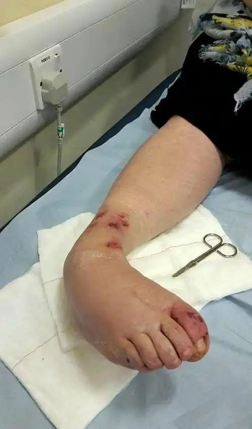 被香水瓶砸到脚剧痛持续两年 小腿截肢后她觉得开心又舒服_网易订阅