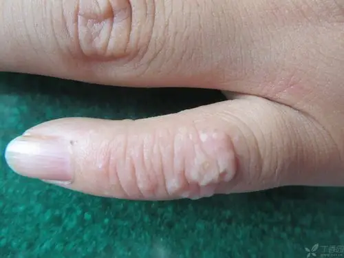 【请教】手指皮疹按湿疹治疗一个月效果不明显怎么办