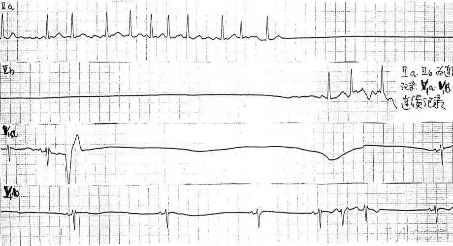 求:心电机械分离 和心室静止 的心电图图形