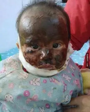 1岁女孩脸被严重烫伤,家人用神奇东西后竟没留疤