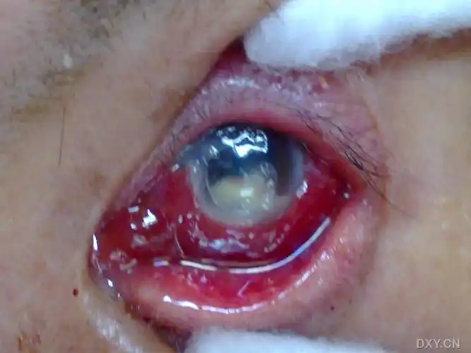 【角膜病讨论】何种角膜溃疡(附眼前节照片)? [精华]