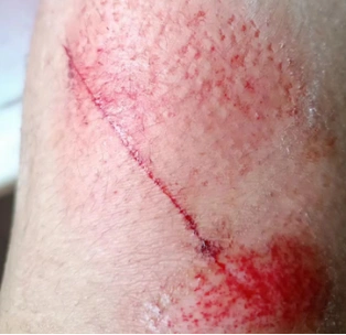 摔伤的腿.图片由受访者提供