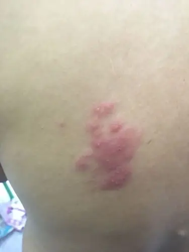 皮肤长了一块红点,看了外面的民间医生说是缠身龙