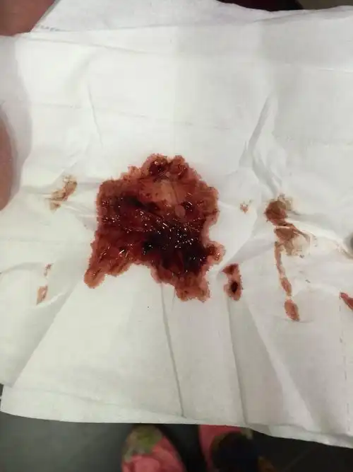 怀孕两个月来月经似的大出血,有血块,很害怕