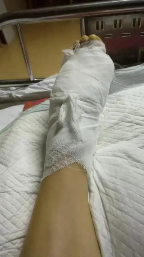 骨折的脚