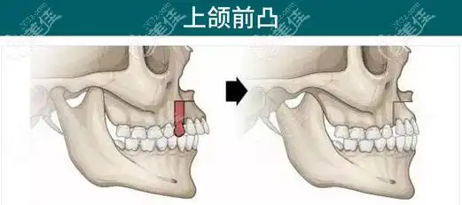 上颚突出