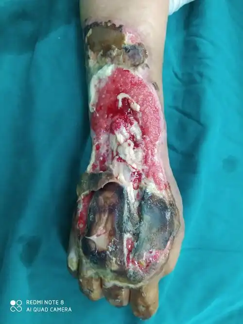 一例右前臂及右手热压伤治疗分享