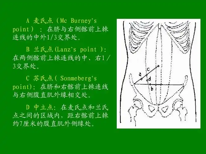 阑尾炎全套课件ppt