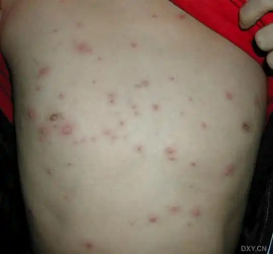 2006-1-5门诊发现一例水痘病人,现将照片上传与各位分享,对从事教学