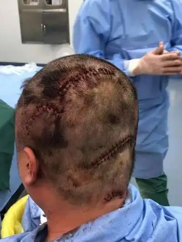 辽宁铁岭昌图家和美发生砍人事件 一男子头部被砍数刀缝了60余针