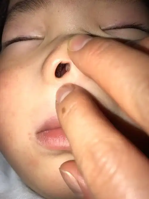 宝宝三岁了,鼻内缝隙很小,经常鼻塞,睡觉声音有时大有时无.最近两