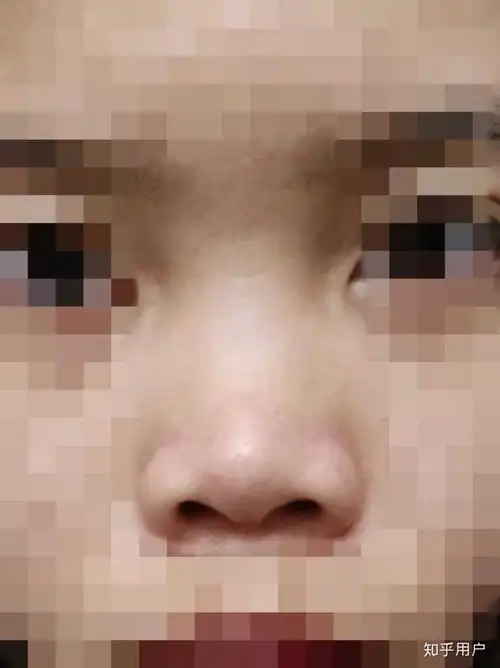 女生塌鼻子是种怎样的体验?