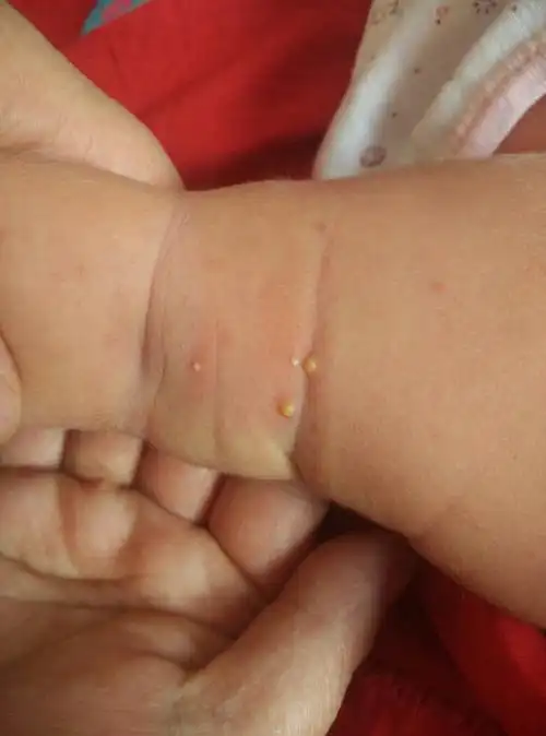 孩子出生刚第八天 小腿弯位置 这起个类似白色的小