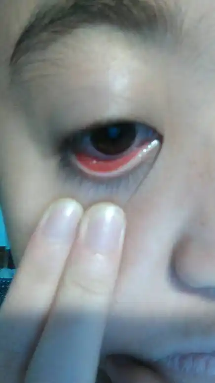 左眼睛肿了…两只眼睛不一样大,发现左眼内眼皮是红的,右眼是好的