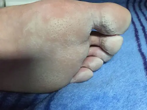 脚一直这样,好像是出汗泡的,感觉臭味都渗进去了,洗