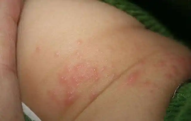 进伏后越来越热怎样避免宝宝红屁股宝妈需学会4招