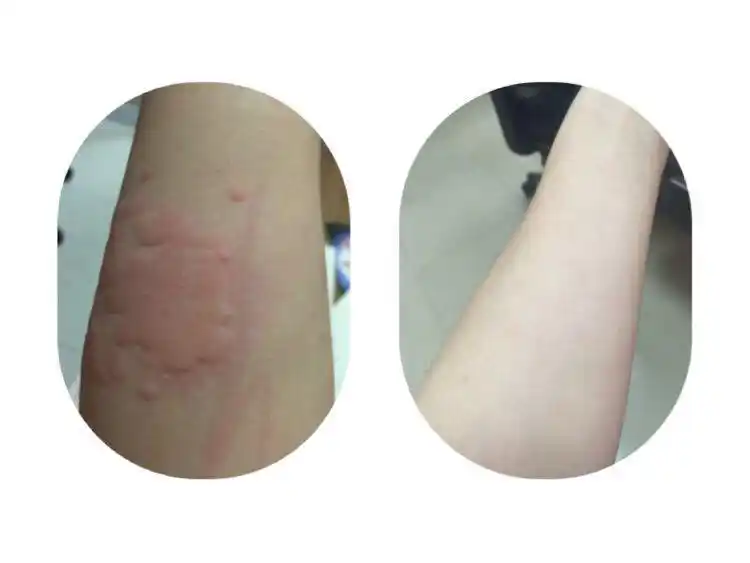 慢性荨麻疹案例