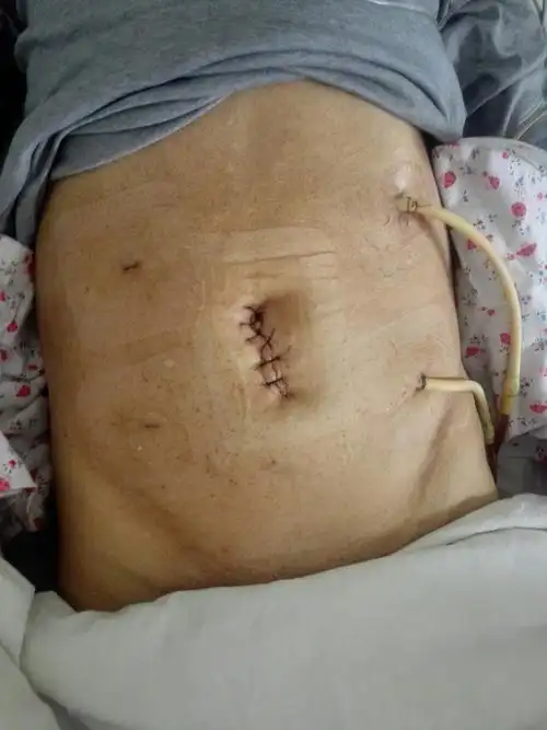 邱县第一例腹腔镜结肠癌根治术