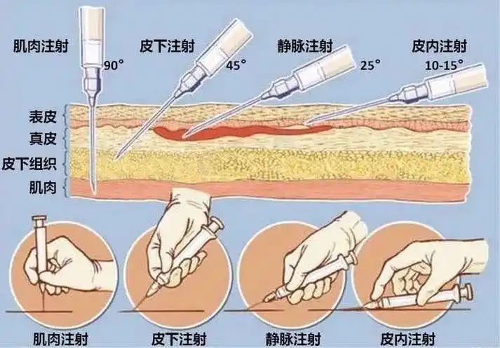 但选择哪种注射方式是很有讲究的,不同的注射方式对注射部位和药物