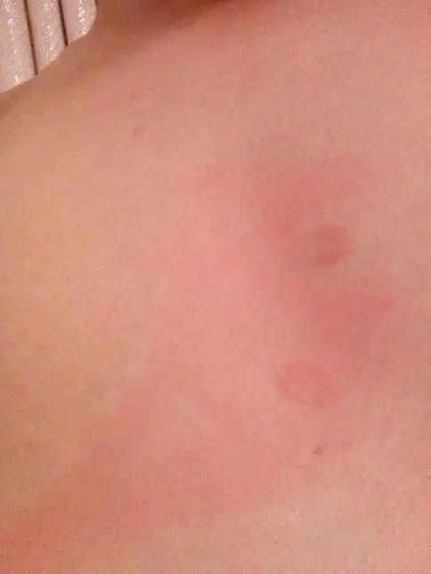 胸部长出这样的斑该怎么恢复?