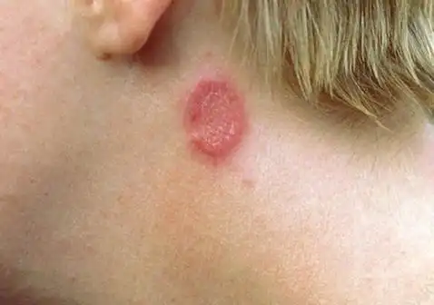 铜钱癣症状图片