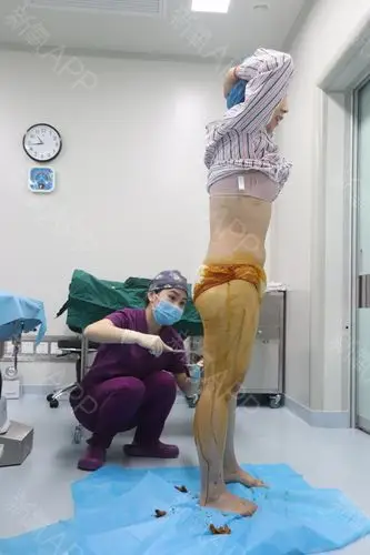 大腿吸脂手术大概用了1小时30分钟,术后医生给我包扎完了,我就去病房
