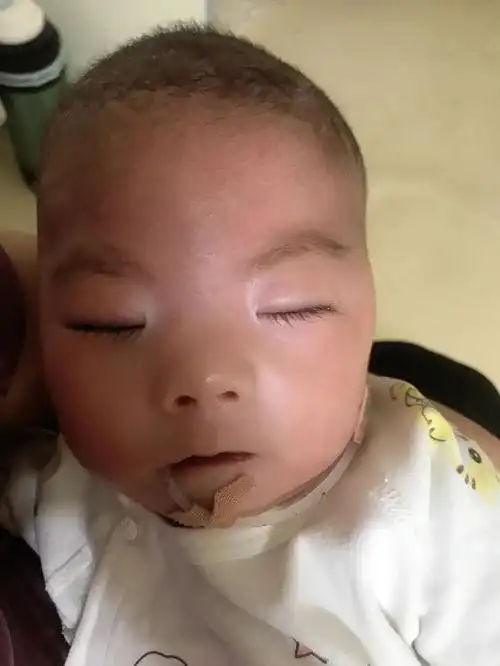 可怜的我宝皮罗综合征